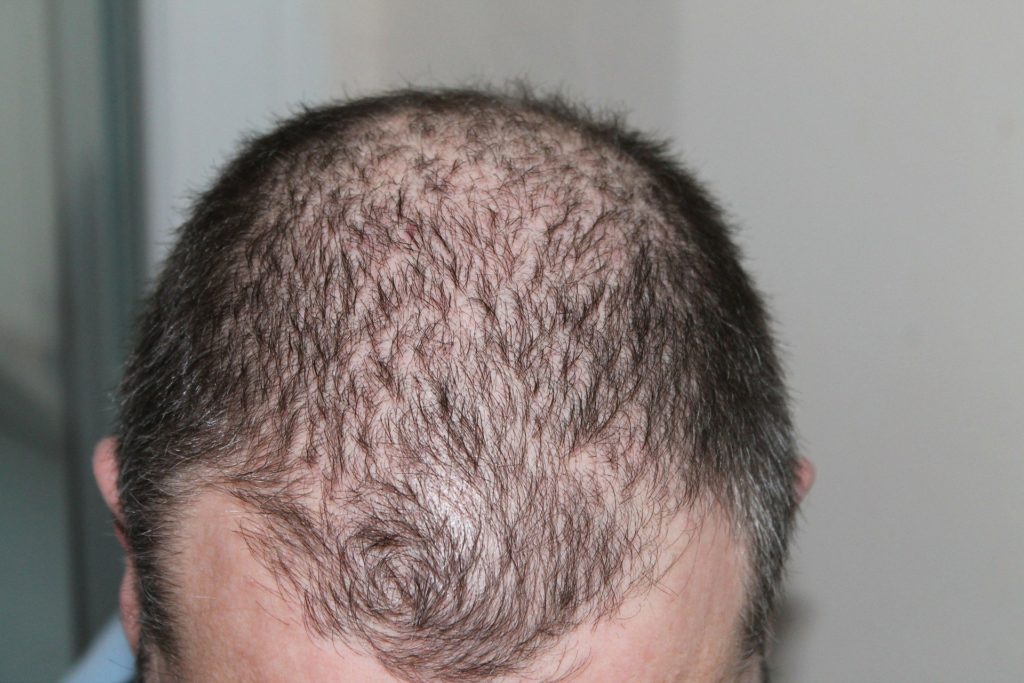 Options Men Can Take for Their Hair Loss Problems
